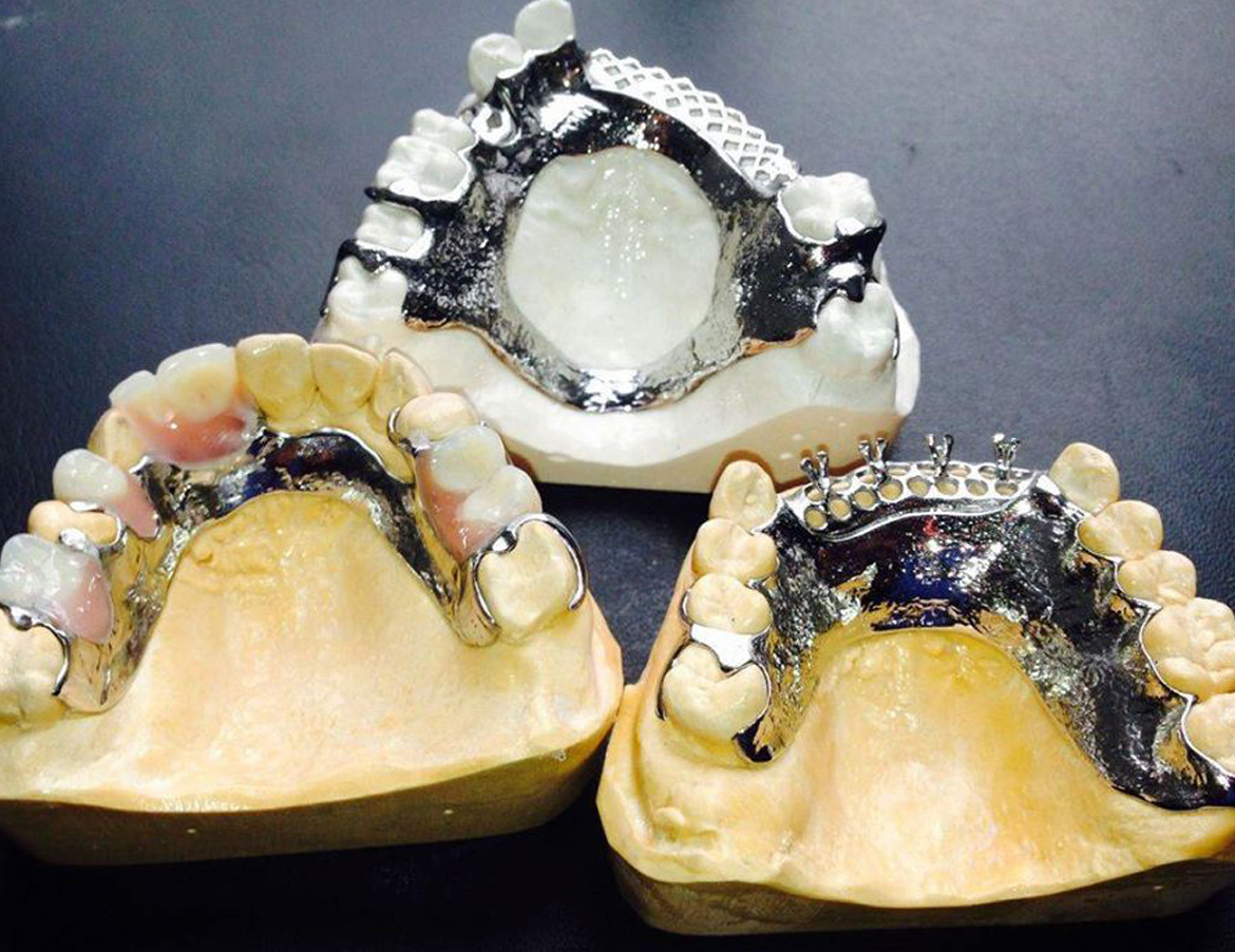 Cobalt Chrome Dentures